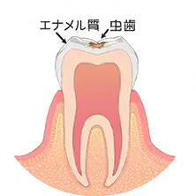 エナメル質の虫歯