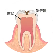 象牙質の虫歯