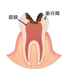 神経まで進行した虫歯