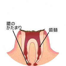 歯根まで進行した虫歯