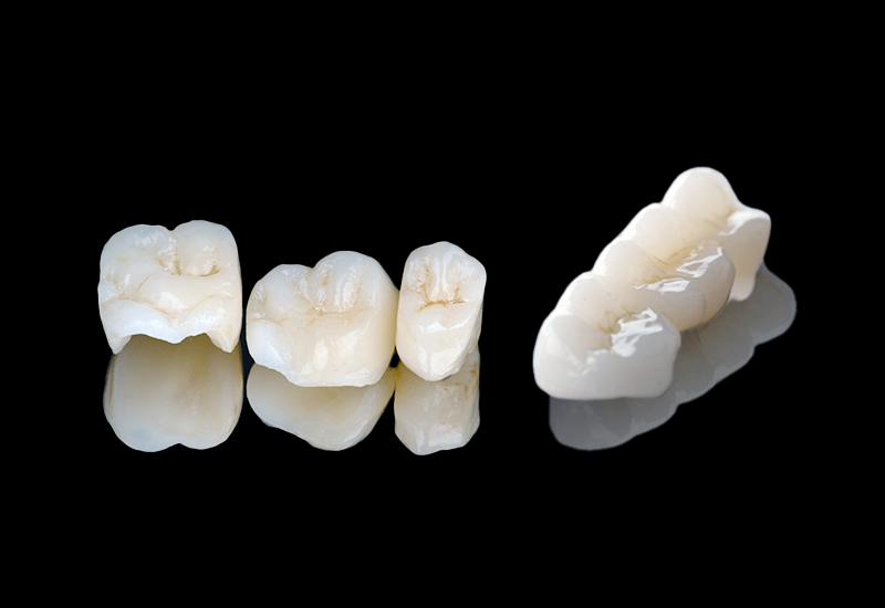 クラウン（被せ物）