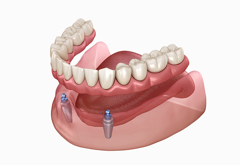 インプラントオーバーデンチャー