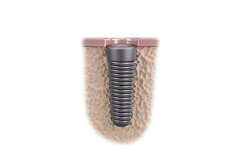 インプラント埋入手術