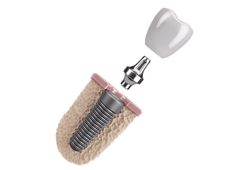 上部構造の装着