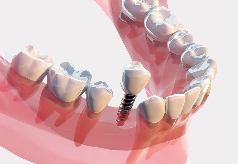 インプラント治療とは