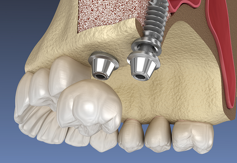 骨造成について