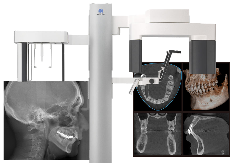 歯科用CT・デジタルレントゲン