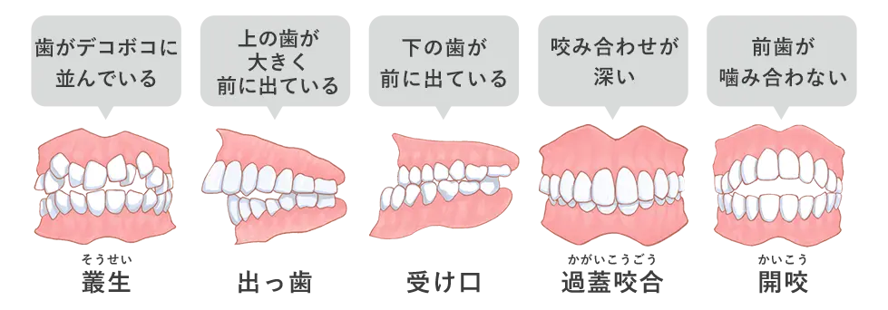 不正咬合