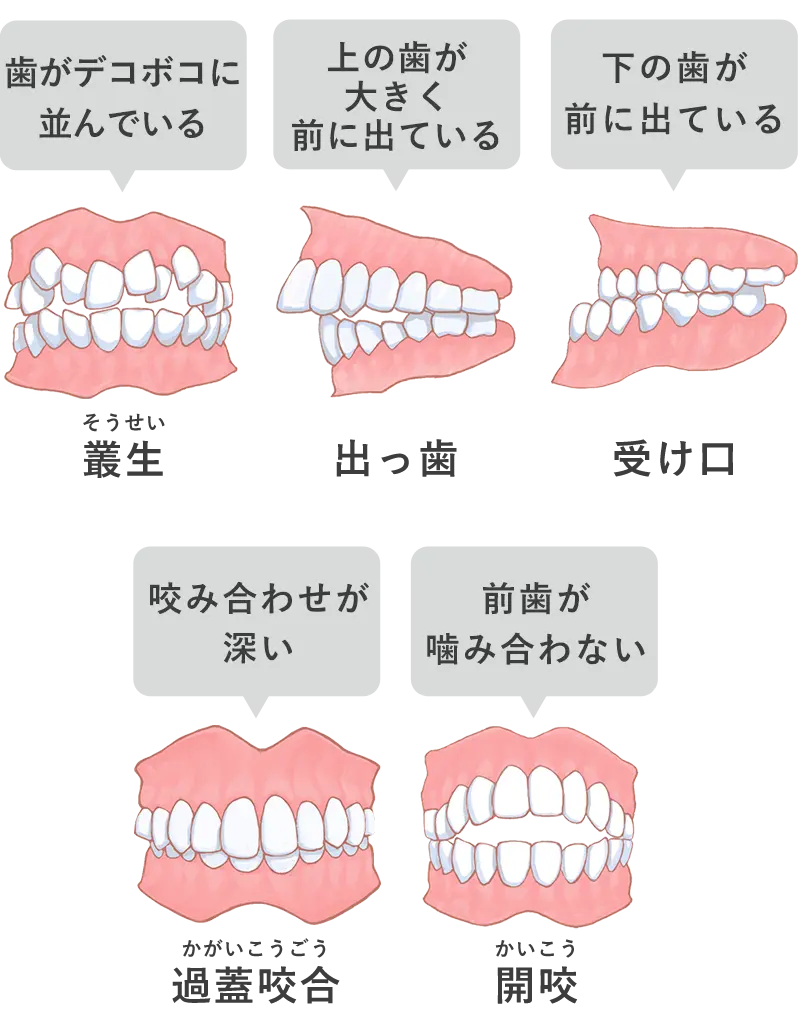 不正咬合