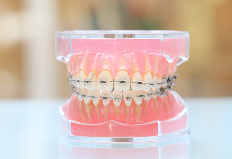 ワイヤー矯正の特徴