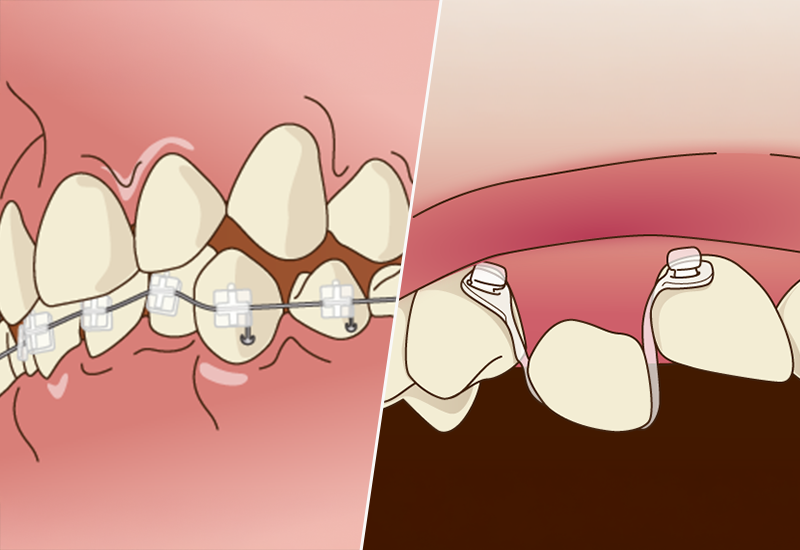部分矯正にも対応