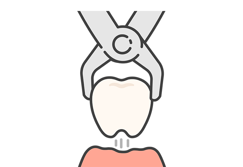 抜歯の可能性を減らせる