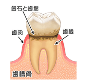歯肉炎(初期段階）