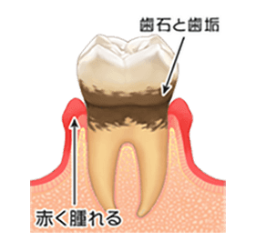 軽度歯周炎