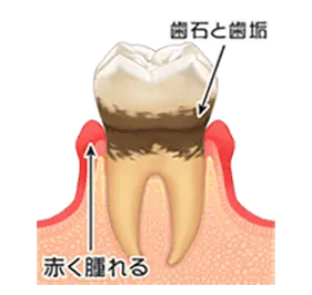 軽度歯周炎