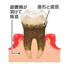 中等度歯周炎