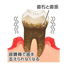 重度歯周炎